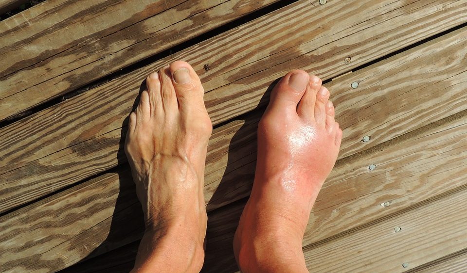 It’s time that we talked about gout – and the 5 foods that can beat it – watch at Brighteon.com