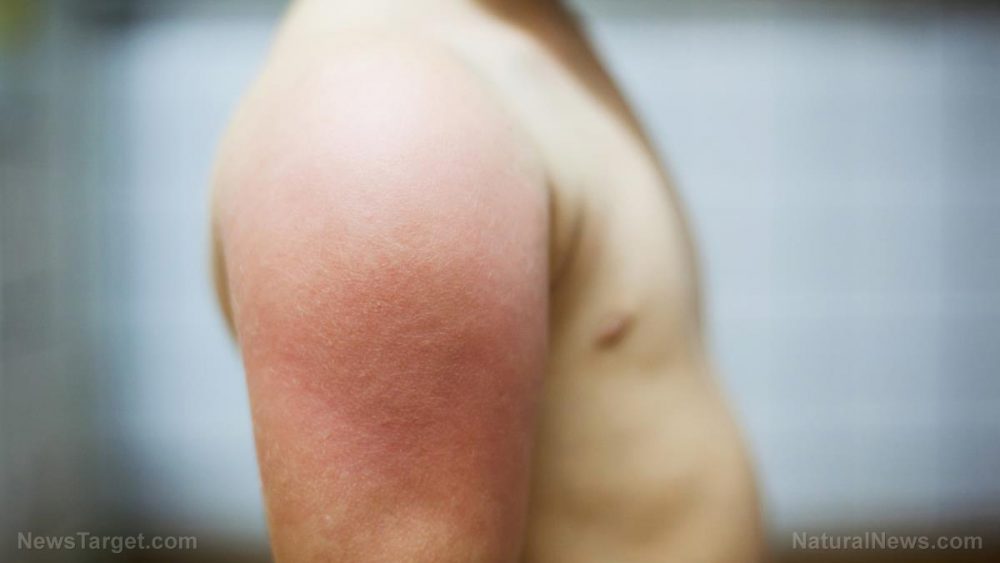 Do you know the signs of an allergic reaction? 7 ways your body tries to tell you