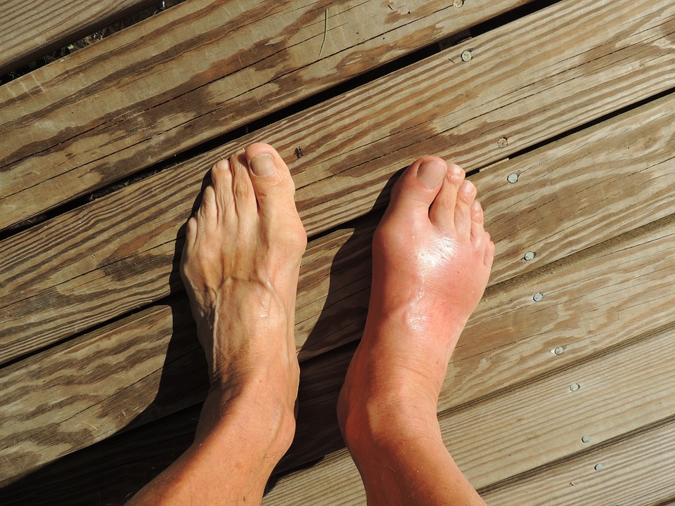 Get natural relief from gout with these 10 home remedies